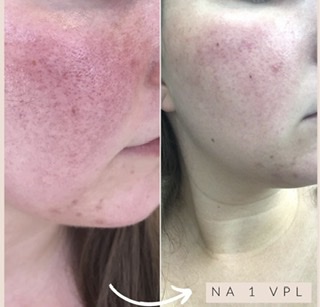 VPL Lasertherapie voor complete huidverjonging