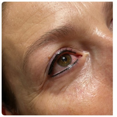 PMU eyeliner bijwerking beide na 1-3 jaar