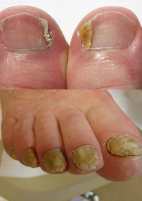 voetverzorging met behandeling voor schimmelnagels